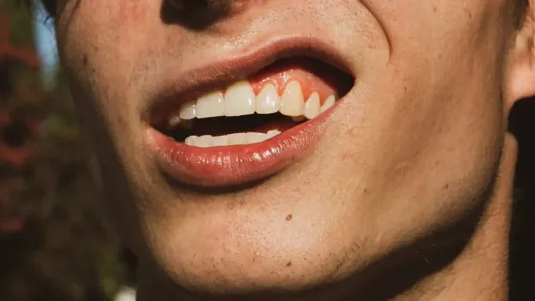 Ontstoken tandvlees gingivitis