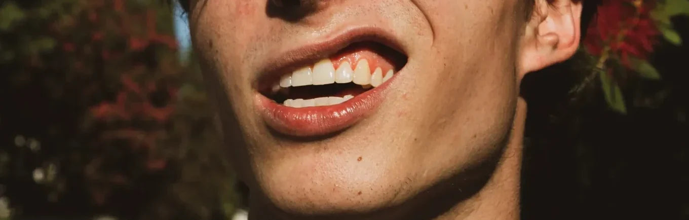 Ontstoken tandvlees gingivitis